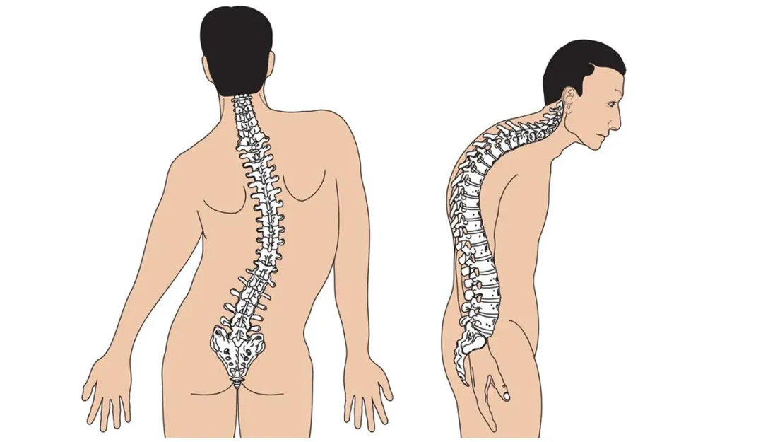 Hội chứng người hóa đá: căn bệnh cực hiếm ở người biến toàn bộ cơ thành xương