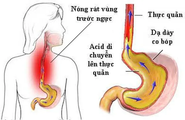 Bác sĩ chỉ cách ăn uống hạn chế trào ngược dạ dày - thực quản