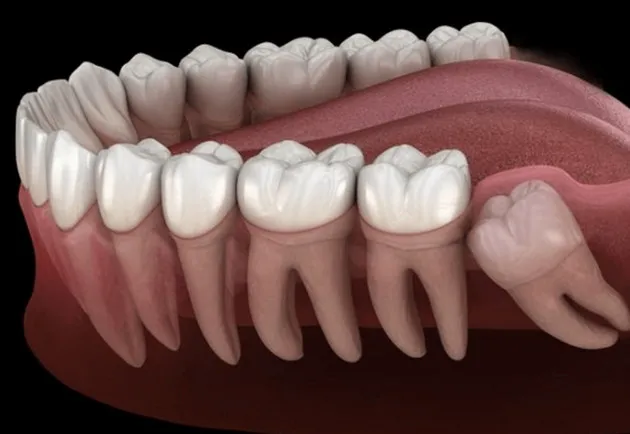 Tại sao răng khôn lại mọc muộn?