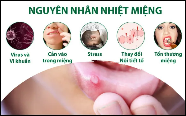 6 lầm tưởng về nhiệt miệng, trong đó có lầm tưởng ai cũng mắc