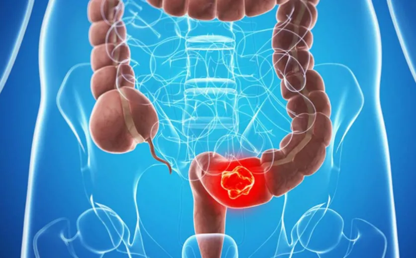 Đột phá điều trị ung thư trực tràng: tìm ra thuốc khiến khối u biến mất hoàn toàn