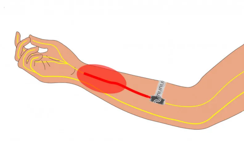 Thiết bị đột phá mới giúp giảm đau mà không cần thuốc