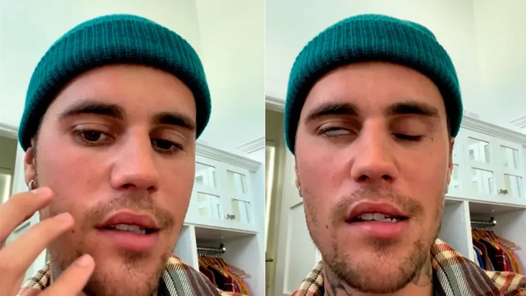 Virus khiến Justin Bieber bị liệt cơ mặt nguy hiểm thế nào?