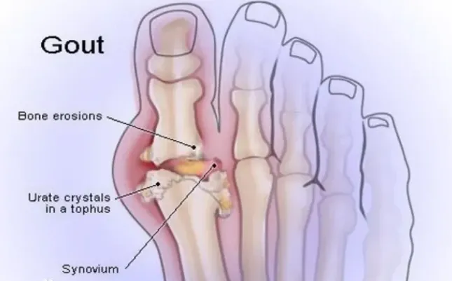 Bệnh gút đau đớn đến chết, tại sao luôn luôn ưu ái đàn ông trung niên?