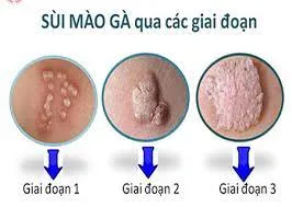 Sùi mào gà có lây qua nhà vệ sinh công cộng không?