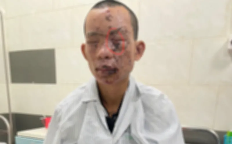 Nam thanh niên bị cháy sém toàn thân, mất thị lực do dùng điện thoại khi đang sạc Nam thanh niên bị cháy sém toàn thân, mất thị lực do dùng điện thoại khi đang sạc