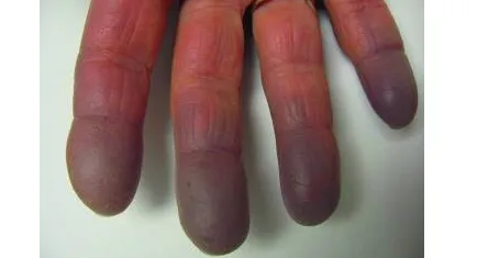 Triệu chứng và Dấu hiệu của hội chứng Raynaud  Triệu chứng và Dấu hiệu của hội chứng Raynaud