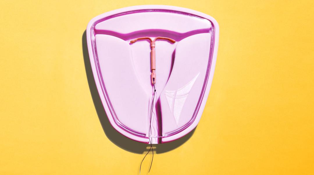 Người phụ nữ đau đớn vì dụng cụ tránh thai hết hạn nhiễm khuẩn sót lại trong tử cung suốt 20 năm Người phụ nữ đau đớn vì dụng cụ tránh thai hết hạn nhiễm khuẩn sót lại trong tử cung suốt 20 năm