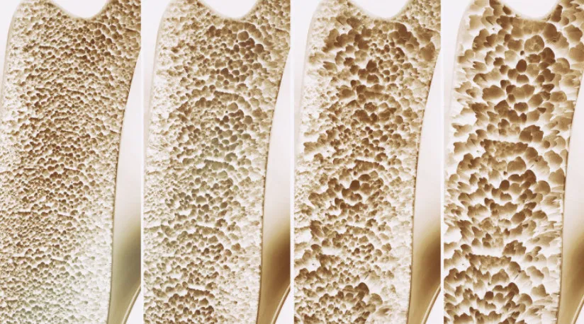 Du hành vũ trụ làm giảm mật độ xương của các phi hành gia Du hành vũ trụ làm giảm mật độ xương của các phi hành gia