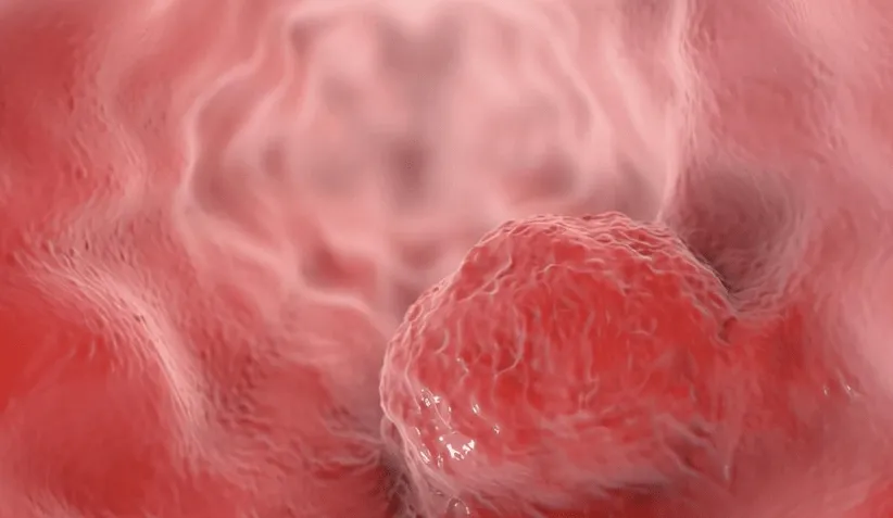 Sau 45 tuổi hãy kiên trì thực hiện 4 lời khuyên này, nó là “công thức” phòng chống ung thư Sau 45 tuổi hãy kiên trì thực hiện 4 lời khuyên này, nó là “công thức” phòng chống ung thư