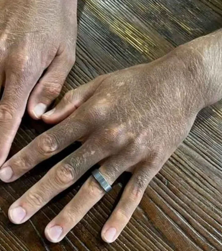 Người đàn ông bị đổi màu da từ trắng sang nâu không rõ nguyên nhân sau khi uống thuốc chống trầm cảm Người đàn ông bị đổi màu da từ trắng sang nâu không rõ nguyên nhân sau khi uống thuốc chống trầm cảm