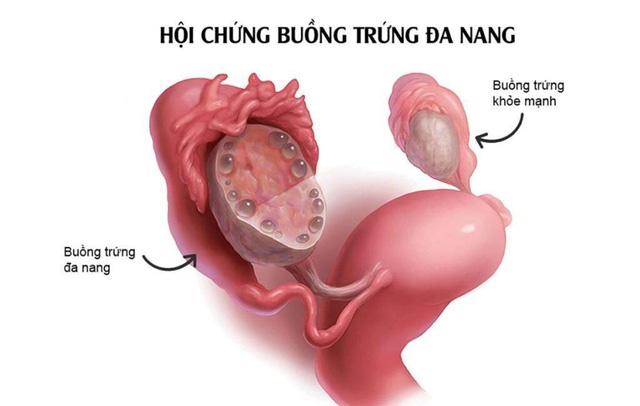 Các lý do phụ nữ có thể bị vô sinh thứ phát sau khi sinh con đầu lòng Các lý do phụ nữ có thể bị vô sinh thứ phát sau khi sinh con đầu lòng