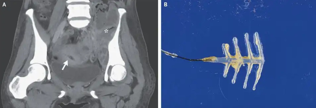 Người phụ nữ đau đớn vì dụng cụ tránh thai hết hạn nhiễm khuẩn sót lại trong tử cung suốt 20 năm Người phụ nữ đau đớn vì dụng cụ tránh thai hết hạn nhiễm khuẩn sót lại trong tử cung suốt 20 năm