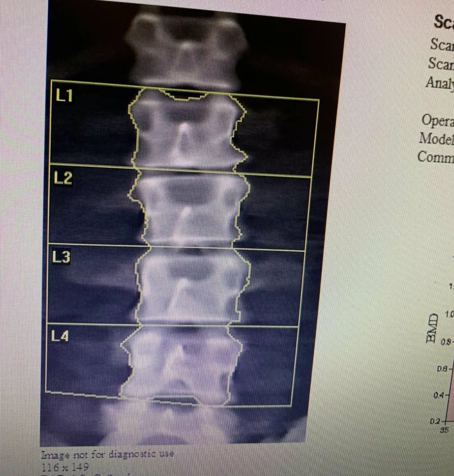 6 tháng ngoài vũ trụ, cột sống phi hành gia trở nên bất thường 6 tháng ngoài vũ trụ, cột sống phi hành gia trở nên bất thường