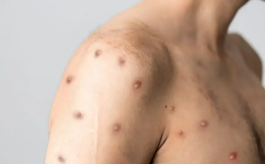 Hy hữu: người đàn ông bị cùng lúc 3 bệnh đậu mùa khỉ, Covid-19 lẫn HIV! Hy hữu: người đàn ông bị cùng lúc 3 bệnh đậu mùa khỉ, Covid-19 lẫn HIV!