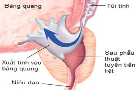 Hiện tượng xuất tinh ngược (còn gọi là cực khoái khô): triệu chứng và cách phòng ngừa Hiện tượng xuất tinh ngược (còn gọi là cực khoái khô): triệu chứng và cách phòng ngừa