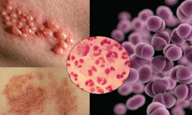 Siêu vi khuẩn lậu ngày càng gia tăng, cẩn trọng khi quan hệ tình dục Siêu vi khuẩn lậu ngày càng gia tăng, cẩn trọng khi quan hệ tình dục