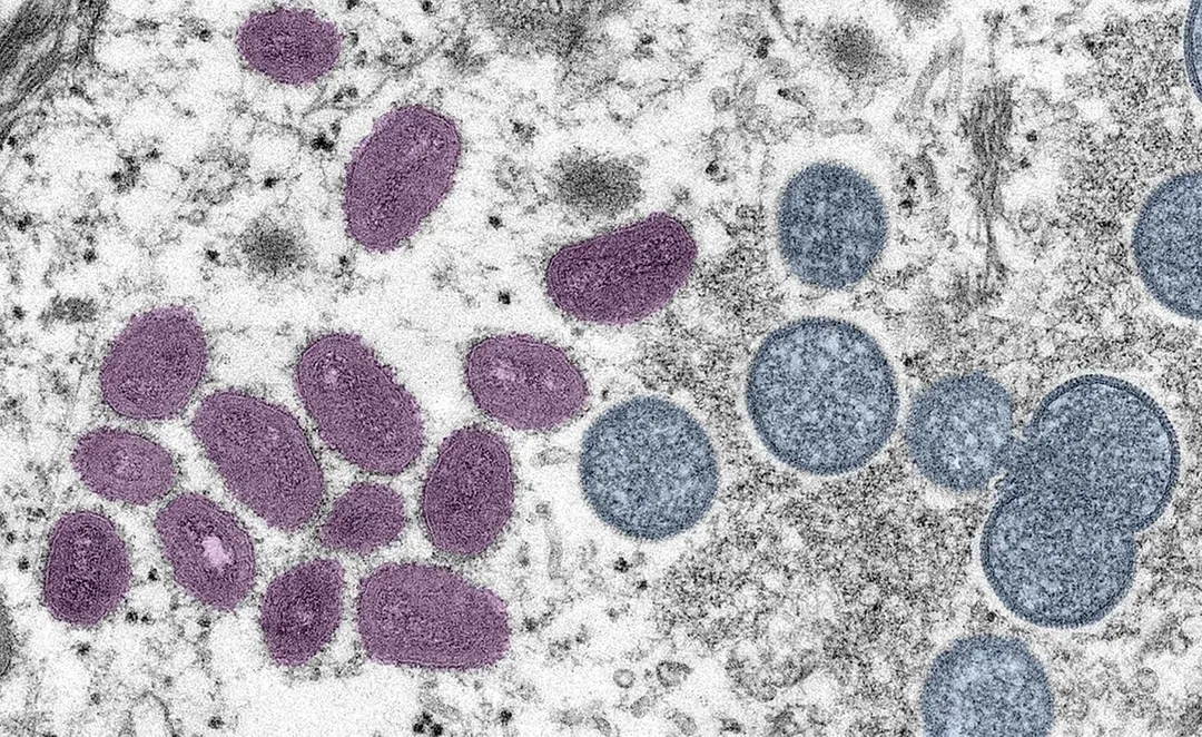 Virus đậu mùa khỉ đột biến với tốc độ chưa từng có Virus đậu mùa khỉ đột biến với tốc độ chưa từng có