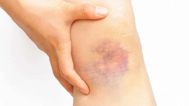 Nếu bạn hay  bị chảy máu và bầm tím, hãy cảnh giác, nó có thể là biểu hiện của ung thư Nếu bạn hay  bị chảy máu và bầm tím, hãy cảnh giác, nó có thể là biểu hiện của ung thư