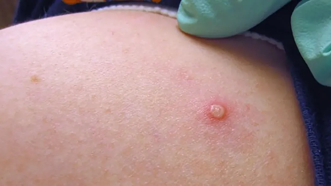 Chủng virus đậu mùa khỉ đang lây lan toàn cầu có 47 đột biến mới Chủng virus đậu mùa khỉ đang lây lan toàn cầu có 47 đột biến mới