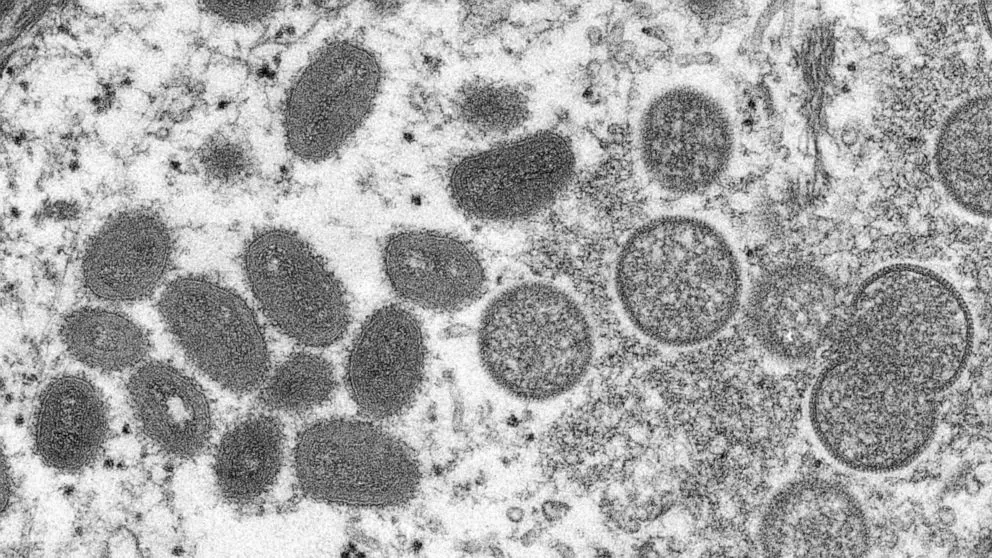 Chủng virus đậu mùa khỉ đang lây lan toàn cầu có 47 đột biến mới Chủng virus đậu mùa khỉ đang lây lan toàn cầu có 47 đột biến mới