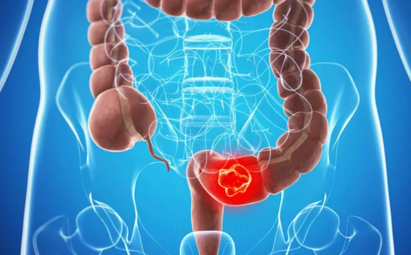 Đột phá điều trị ung thư trực tràng: tìm ra thuốc khiến khối u biến mất hoàn toàn Đột phá điều trị ung thư trực tràng: tìm ra thuốc khiến khối u biến mất hoàn toàn